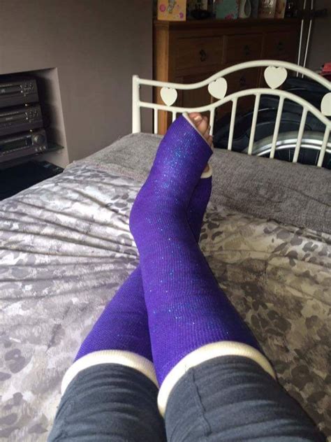 leg cast with sock